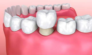 Скидка 23% на металлокерамическую коронку и коронку из Диоксида циркония на собственный зуб